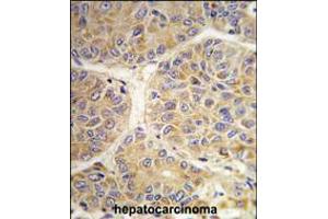 Formalin-fixed and paraffin-embedded human hepatocarcinoma tissue reacted with the AASS antibody , which was peroxidase-conjugated to the secondary antibody, followed by DAB staining. (AASS Antikörper  (AA 264-294))