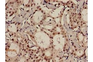 Immunohistochemistry analysis of human breast cancer using ABIN7159096 at dilution of 1:100 (MDC1 Antikörper  (AA 1892-2082))
