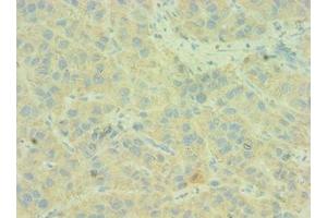 Immunohistochemistry of paraffin-embedded human liver cancer using ABIN7146168 at dilution of 1:100 (C4BPB Antikörper  (AA 18-252))