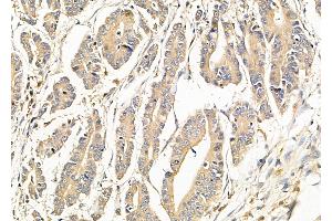 ABIN6265478 and ABIN6279868 at 1/100 staining Human pancreatic cancer by IHC-P.