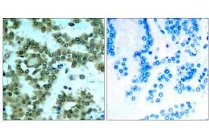 Immunohistochemical analysis of paraffin-embedded human lung carcinoma tissue, using PKCθ (phospho- Ser676) antibody (E011297). (PKC theta Antikörper  (pSer676))
