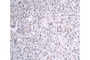 DAB staining on IHC-P; Samples: Human Glioma Tissue (APOA1 Antikörper  (AA 122-267))
