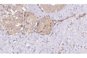 ABIN6273326 at 1/100 staining Human thyroid cancer tissue by IHC-P.
