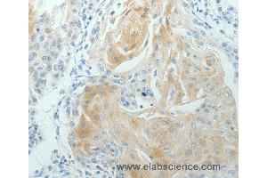 Immunohistochemistry of Human cervical cancer using RNF126 Polyclonal Antibody at dilution of 1:70 (RNF126 Antikörper)