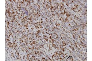 Immunoperoxidase of monoclonal antibody to RAB27A on formalin-fixed paraffin-embedded human lymphoma.
