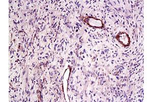 Formalin-fixed and paraffin embedded human laryngeal cancer labeled Anti-CTGF Polyclonal Antibody, Unconjugated (ABIN672636) at 1:200, followed by conjugation to the secondary antibody and DAB staining