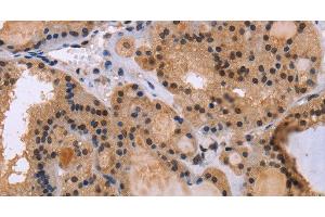 Immunohistochemistry of paraffin-embedded Human thyroid cancer tissue using KIF25 Polyclonal Antibody at dilution 1:40 (KIF25 Antikörper)