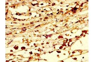 IHC image of ABIN7168252 diluted at 1:300 and staining in paraffin-embedded human melanoma performed on a Leica BondTM system. (RNF219 Antikörper  (AA 257-465))