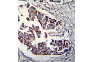 Formalin fixed, paraffin embedded human breast carcinoma stained with RAD9A Antibody  followed by peroxidase conjugation of the secondary antibody and DAB staining. (RAD9A Antikörper)