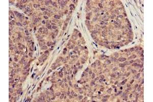 Immunohistochemistry of paraffin-embedded human ovarian cancer using ABIN7169889 at dilution of 1:100 (SUMO3 Antikörper  (AA 1-92))