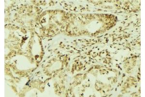 ABIN6267095 at 1/100 staining Human breast cancer tissue by IHC-P. (BAP1 Antikörper  (pSer592))