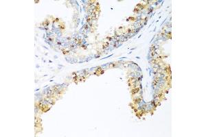 Immunohistochemistry of paraffin-embedded human prostate using LRP5 antibody (ABIN5974915) at dilution of 1/200 (40x lens). (LRP5 Antikörper)