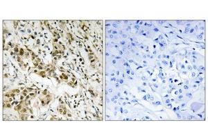Immunohistochemistry analysis of paraffin-embedded human breast carcinoma tissue using CtBP1 (epitope around residue 422) antibody. (CTBP1 Antikörper  (Ser422))