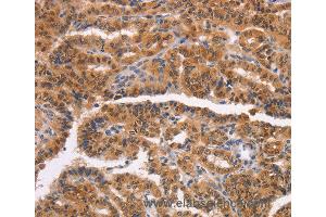 Immunohistochemistry of Human liver cancer using NCAPG2 Polyclonal Antibody at dilution of 1:50 (NCAPG2 Antikörper)