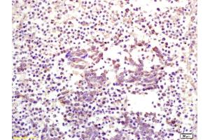 Formalin-fixed and paraffin embedded human lung carcinoma labeled with Anti CKIP-1 Polyclonal Antibody, Unconjugated (ABIN675039) at 1:200 followed by conjugation to the secondary antibody and DAB staining (PLEKHO1 Antikörper  (AA 51-170))