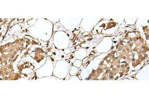 Immunohistochemistry of paraffin-embedded Human breast cancer tissue using UBE2Z Polyclonal Antibody at dilution of 1:35(x200) (UBE2Z Antikörper)