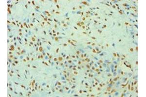 Immunohistochemistry of paraffin-embedded human breast cancer using ABIN7175904 at dilution of 1:100 (XRCC5 Antikörper  (AA 543-732))