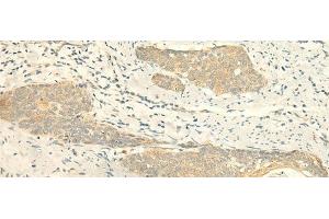 Immunohistochemistry of paraffin-embedded Human esophagus cancer tissue using MPV17 Polyclonal Antibody at dilution of 1:50(x200) (MPV17 Antikörper)