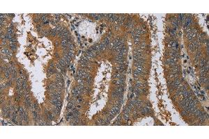 Immunohistochemistry of paraffin-embedded Human colon cancer using HSP40-4 Polyclonal Antibody at dilution of 1:60 (HSP40-4 Antikörper)