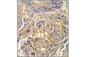 Formalin-fixed and paraffin-embedded human colon carcinoma tissue reacted with Autophagy APG16L Antibody , which was peroxidase-conjugated to the secondary antibody, followed by DAB staining. (ATG16L1 Antikörper  (AA 84-114))