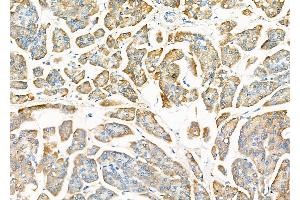 ABIN6265353 and ABIN6273171 at 1/100 staining Human pancreatic cancer and adjacent nomal tissues by IHC-P.