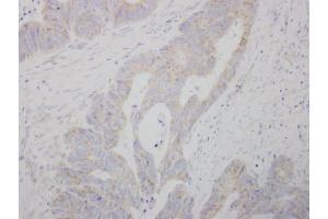 IHC-P Image COMT antibody detects COMT protein at cytosol on human colon carcinoma by immunohistochemical analysis. (COMT Antikörper)