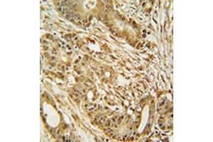 Immunohistochemistry analysis in formalin fixed and paraffin embedded human colon carcinoma reacted with MCM2 Antibody (C-term) followed which was peroxidase conjugated to the secondary antibody and followed by DAB staining. (MCM2 Antikörper  (C-Term))