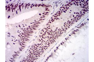 Immunohistochemical analysis of paraffin-embedded rectum cancer tissues using KMT2D mouse mAb with DAB staining. (Lysine (K)-Specific Methyltransferase 2B (KMT2B) (AA 445-599) Antikörper)
