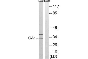 Immunohistochemistry analysis of paraffin-embedded human colon carcinoma tissue, using CA1 antibody. (CA1 Antikörper)