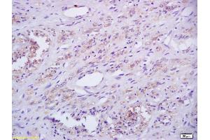 Formalin-fixed and paraffin embedded human cervical carcinoma labeled with Rabbit Anti Phospho-IRAK1 (Thr387) Polyclonal Antibody, Unconjugated (ABIN742673) at 1:200 followed by conjugation to the secondary antibody and DAB staining (IRAK1 Antikörper  (pThr387))