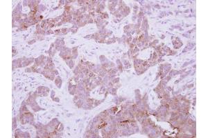 IHC-P Image Immunohistochemical analysis of paraffin-embedded human breast cancer, using CPNE6, antibody at 1:250 dilution. (CPNE6 Antikörper)