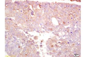 Formalin-fixed and paraffin embedded human lung carcinoma labeled with Anti-TRPM7 Polyclonal Antibody, Unconjugated  at 1:200 followed by conjugation to the secondary antibody and DAB staining (TRPM7 Antikörper  (AA 800-850))