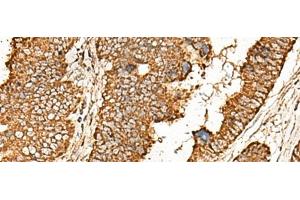 Immunohistochemistry of paraffin-embedded Human colorectal cancer tissue using ATP5I Polyclonal Antibody at dilution of 1:65(x200) (ATP5I Antikörper)