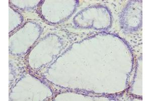Immunohistochemistry of paraffin-embedded human colon cancer using ABIN7153655 at dilution of 1:100 (MLZE Antikörper  (AA 1-508))