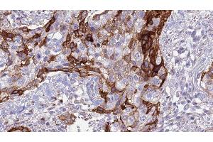 ABIN6276996 at 1/100 staining Human urothelial cancer tissue by IHC-P.