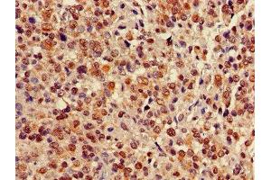 Immunohistochemistry of paraffin-embedded human glioma using ABIN7147705 at dilution of 1:100 (CBX5 Antikörper  (AA 1-191))