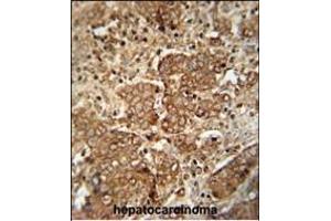 CS antibody (C-term) 10677b immunohistochemistry analysis in formalin fixed and paraffin embedded human hepatocarcinoma followed by peroxidase conjugation of the secondary antibody and DAB staining.