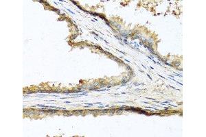 Immunohistochemistry of paraffin-embedded Human prostate using SOST Polyclonal Antibody at dilution of 1:100 (40x lens). (Sclerostin Antikörper)