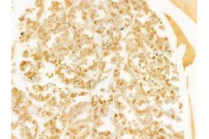 ABIN6263190 and ABIN6279525 at 1/100 staining human renal cell carcinoma by IHC-P. (MED15 Antikörper  (C-Term))
