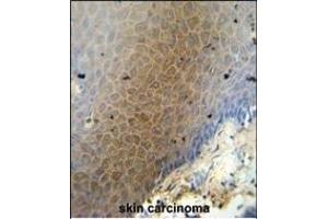 CEP70 antibody (Center) (ABIN654603 and ABIN2844302) immunohistochemistry analysis in formalin fixed and paraffin embedded human skin carcinoma followed by peroxidase conjugation of the secondary antibody and DAB staining.