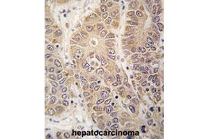 Formalin-fixed and paraffin-embedded human hepatocarcinomareacted with HARS polyclonal antibody , which was peroxidase-conjugated to the secondary antibody, followed by AEC staining. (HARS1/Jo-1 Antikörper  (N-Term))