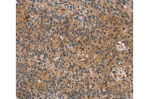 Immunohistochemistry of Human cervical cancer using TAC1 Polyclonal Antibody at dilution of 1:25