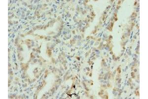 Immunohistochemistry of paraffin-embedded human lung cancer using ABIN7170902 at dilution of 1:100 (SDHC Antikörper  (AA 30-62))