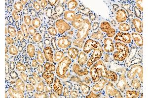 ABIN6266358 and ABIN6276703 at 1/100 staining Human kidney cancer and adjacent normal tissues by IHC-P. (PICK1 Antikörper  (N-Term))