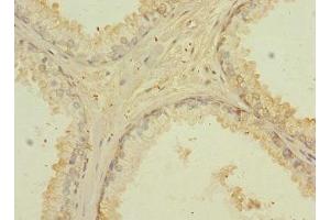 Immunohistochemistry of paraffin-embedded human prostate cancer using ABIN7147148 at dilution of 1:100 (CD276 Antikörper  (AA 29-200))