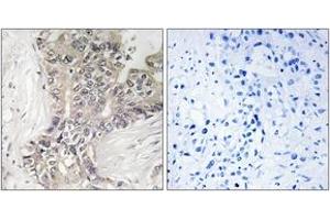 Immunohistochemistry analysis of paraffin-embedded human liver carcinoma tissue, using B3GALTL Antibody. (B3GALTL Antikörper  (AA 449-498))