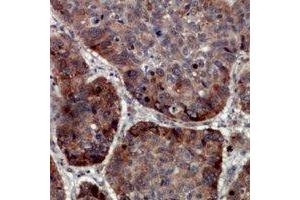 Immunohistochemical analysis of TRAPPC5 staining in human lung cancer formalin fixed paraffin embedded tissue section. (TRAPPC5 Antikörper)