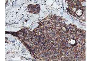 Immunohistochemical staining of paraffin-embedded Adenocarcinoma of Human breast tissue using anti-NPTN mouse monoclonal antibody. (NPTN Antikörper)