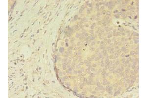 Immunohistochemistry of paraffin-embedded human gastric cancer using ABIN7144805 at dilution of 1:100 (ATXN7L3 Antikörper  (AA 51-347))