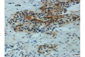 Immunohistochemistry of paraffin-embedded human cervical carcinoma using MMP1 antibody. (MMP1 Antikörper)